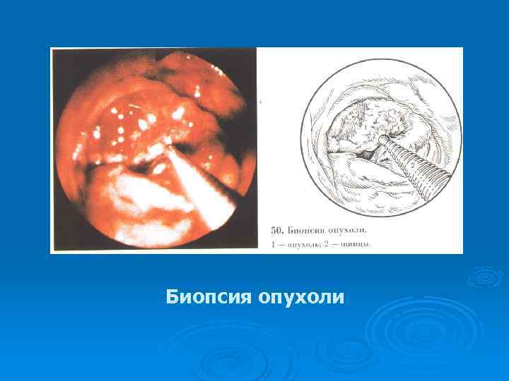 Биопсия опухоли 