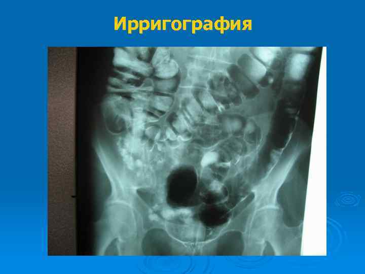 Ирригография 