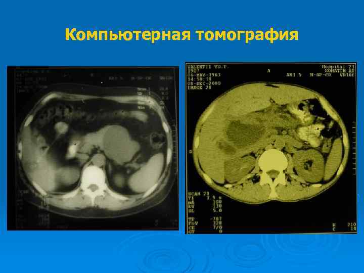 Компьютерная томография 