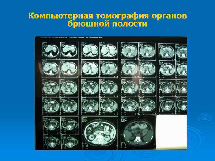 Компьютерная томография органов брюшной полости 