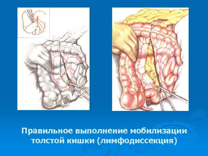 Правильное выполнение мобилизации толстой кишки (лимфодиссекция) 