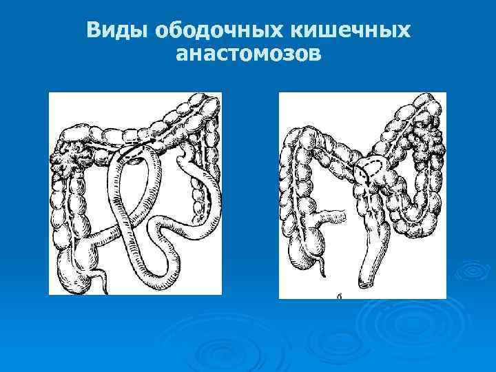 Виды ободочных кишечных анастомозов 