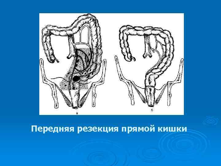 Схема операция гартмана