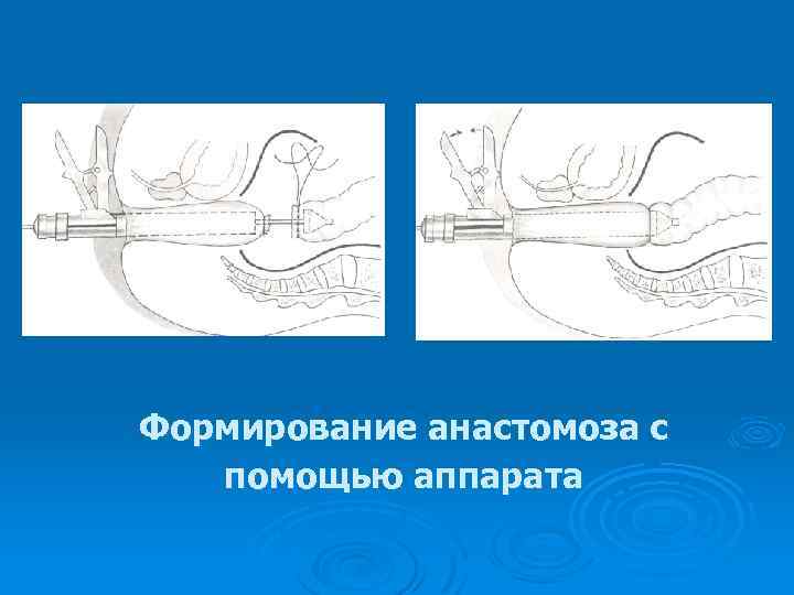 Формирование анастомоза с помощью аппарата 