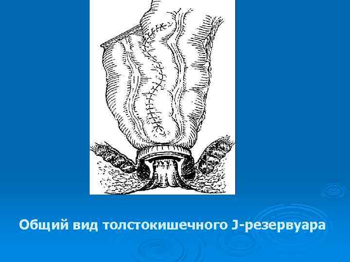 Общий вид толстокишечного J-резервуара 