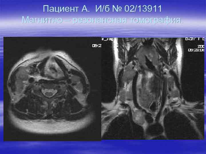 Пациент А. И/б № 02/13911 Магнитно – резонансная томография. 