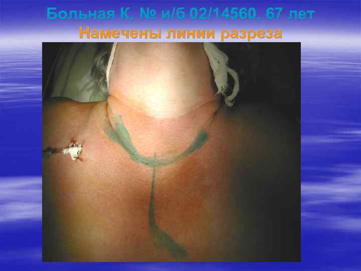 Больная К, № и/б 02/14560, 67 лет Намечены линии разреза 