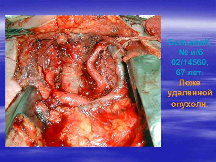 Больная. К, № и/б 02/14560, 67 лет. Ложе удаленной опухоли. 