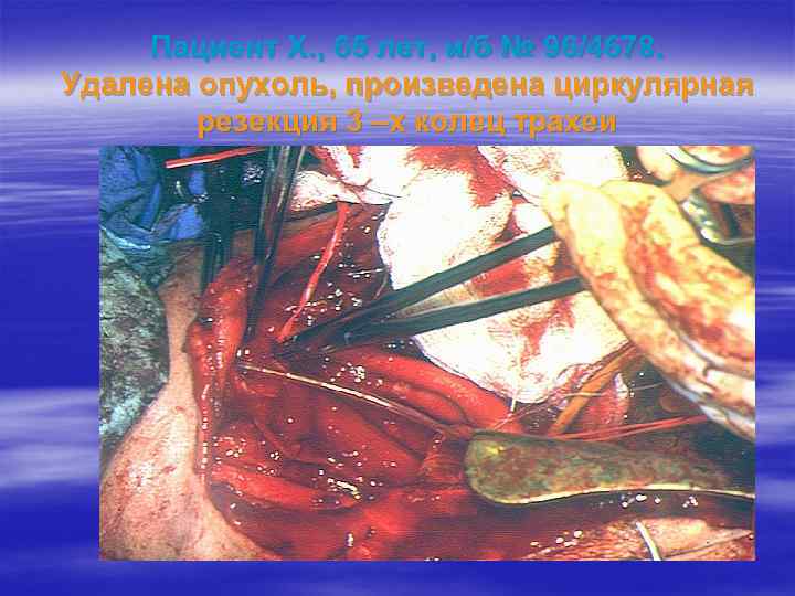 Пациент Х. , 65 лет, и/б № 96/4678. Удалена опухоль, произведена циркулярная резекция 3