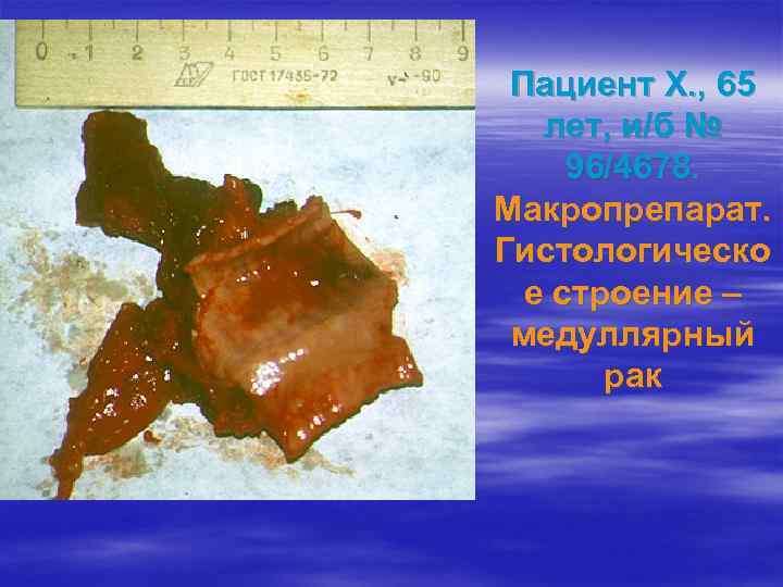 Пациент Х. , 65 лет, и/б № 96/4678. Макропрепарат. Гистологическо е строение – медуллярный