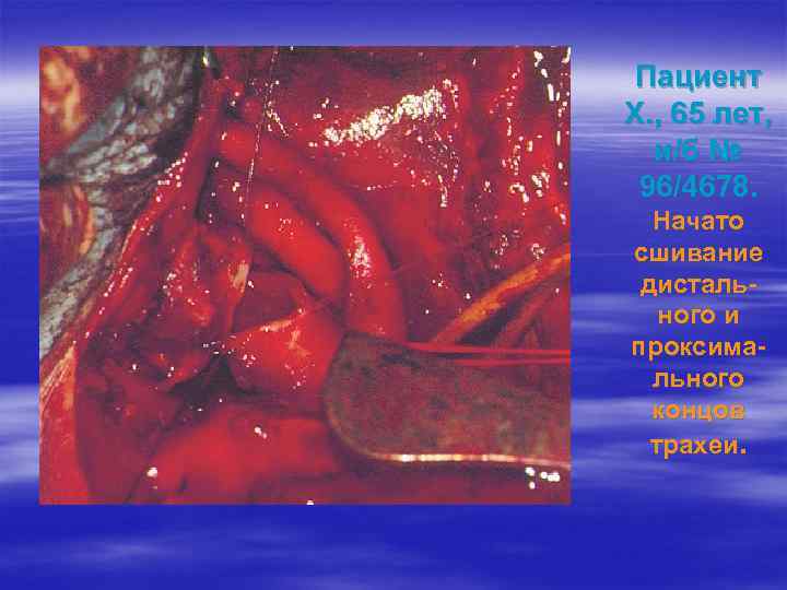 Пациент Х. , 65 лет, и/б № 96/4678. Начато сшивание дистального и проксимального концов