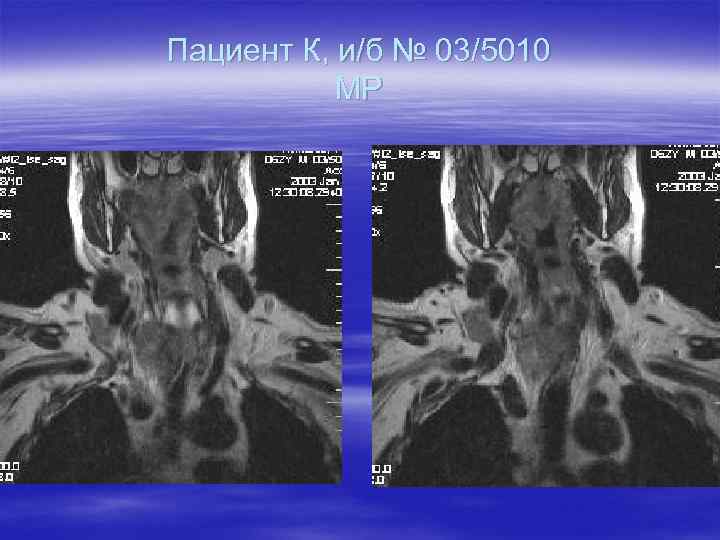 Пациент К, и/б № 03/5010 МР 