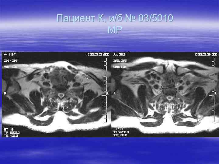 Пациент К, и/б № 03/5010 МР 
