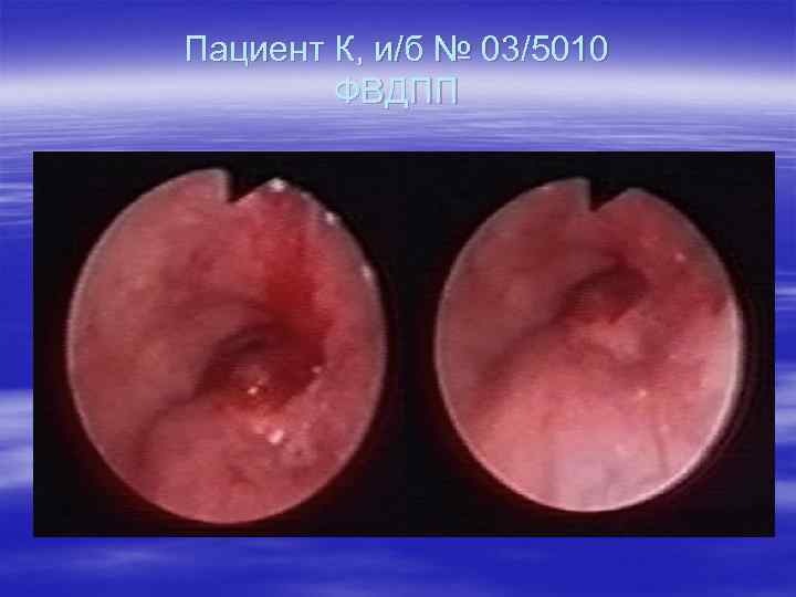 Пациент К, и/б № 03/5010 ФВДПП 