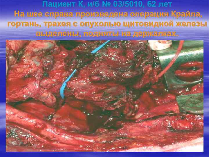 Пациент К, и/б № 03/5010, 62 лет На шее справа произведена операция Крайла, гортань,