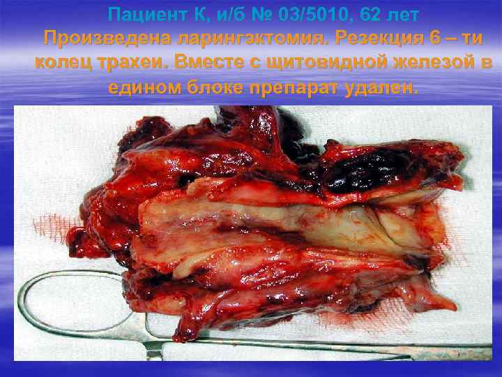 Пациент К, и/б № 03/5010, 62 лет Произведена ларингэктомия. Резекция 6 – ти колец