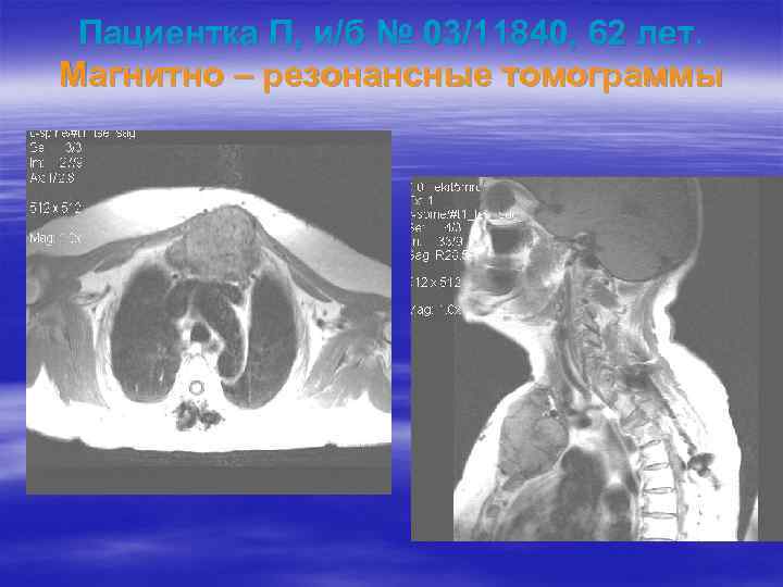 Пациентка П, и/б № 03/11840, 62 лет. Магнитно – резонансные томограммы 