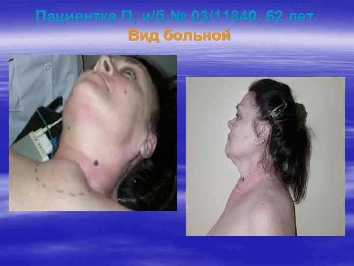 Пациентка П, и/б № 03/11840, 62 лет. Вид больной 