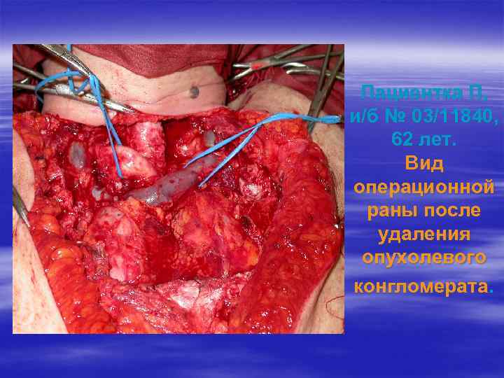 Пациентка П, и/б № 03/11840, 62 лет. Вид операционной раны после удаления опухолевого конгломерата.