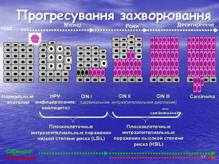 Час Прогресування захворювання Десятирічччя Місяці Роки HPV CIN III Нормальный CIN I эпителий инфицирование;