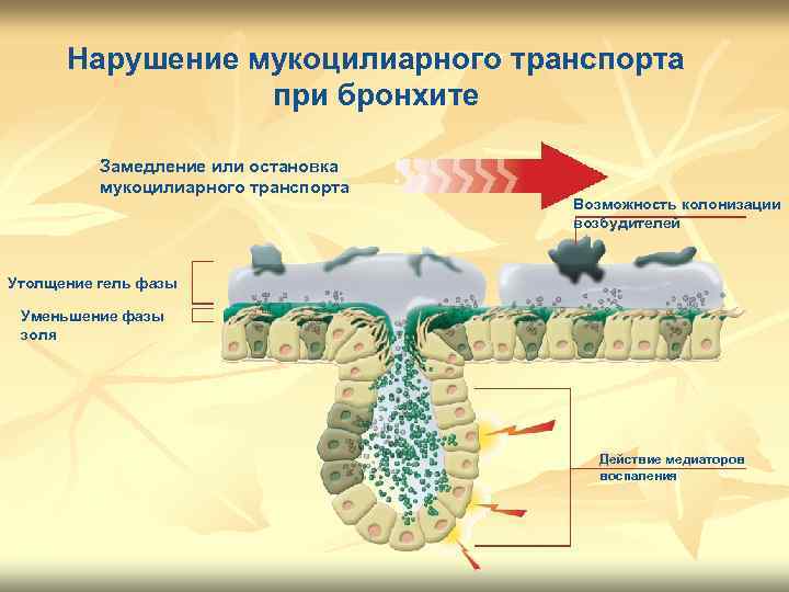 Нарушение мукоцилиарного транспорта при бронхите Замедление или остановка мукоцилиарного транспорта Возможность колонизации возбудителей Утолщение