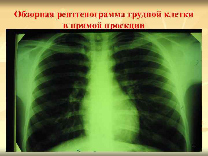 Обзорная рентгенограмма грудной клетки в прямой проекции 20 