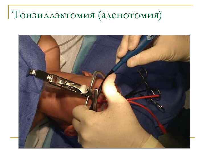 Тонзиллэктомия (аденотомия) 