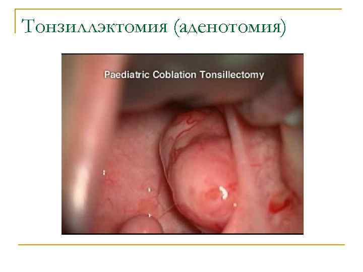 Тонзиллэктомия (аденотомия) 