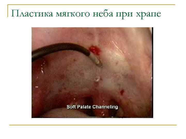 Пластика мягкого неба при храпе 