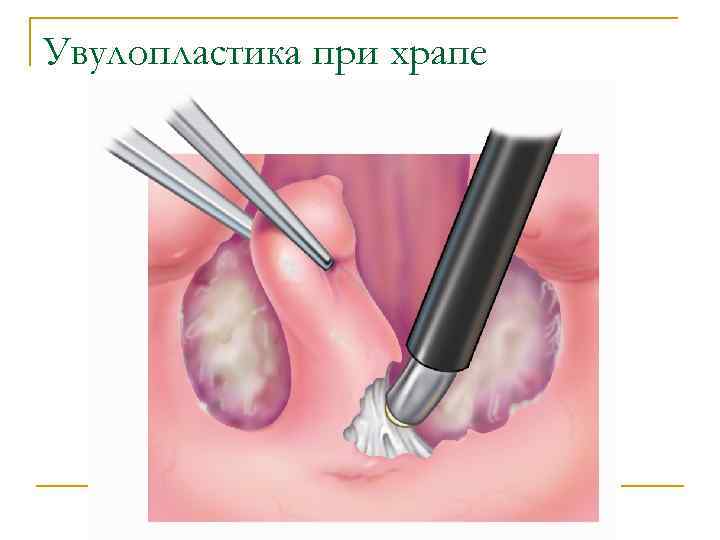 Увулопластика при храпе 