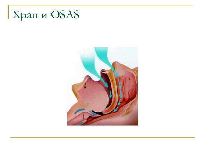 Храп и OSAS 