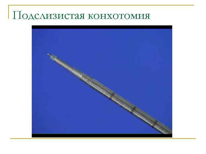 Подслизистая конхотомия 