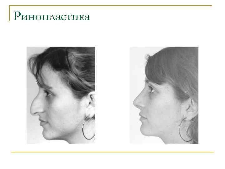 Ринопластика 