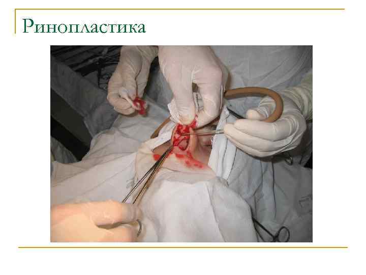 Ринопластика 