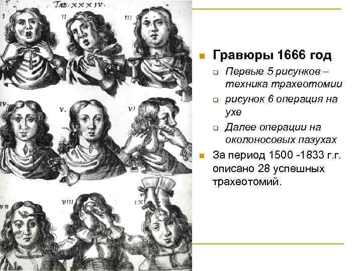 n Гравюры 1666 год Первые 5 рисунков – техника трахеотомии q рисунок 6 операция