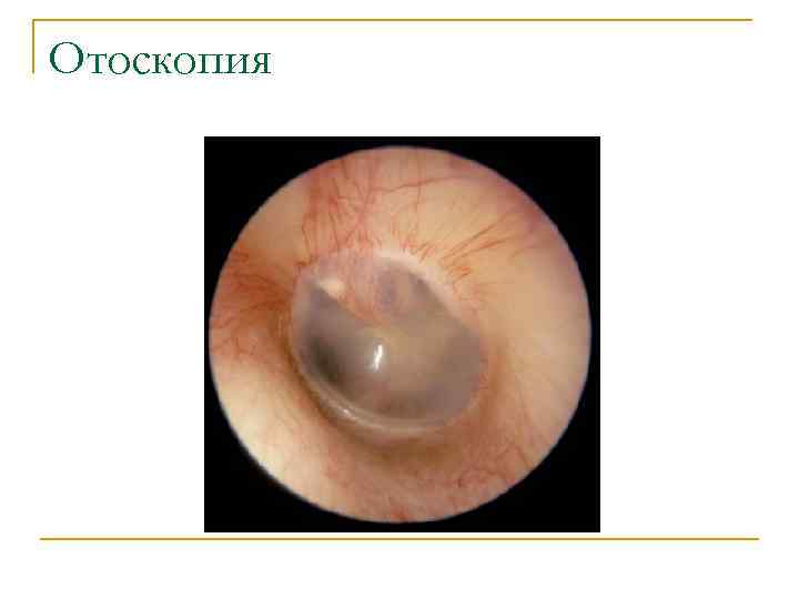 Отоскопия 
