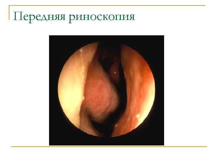 Передняя риноскопия 