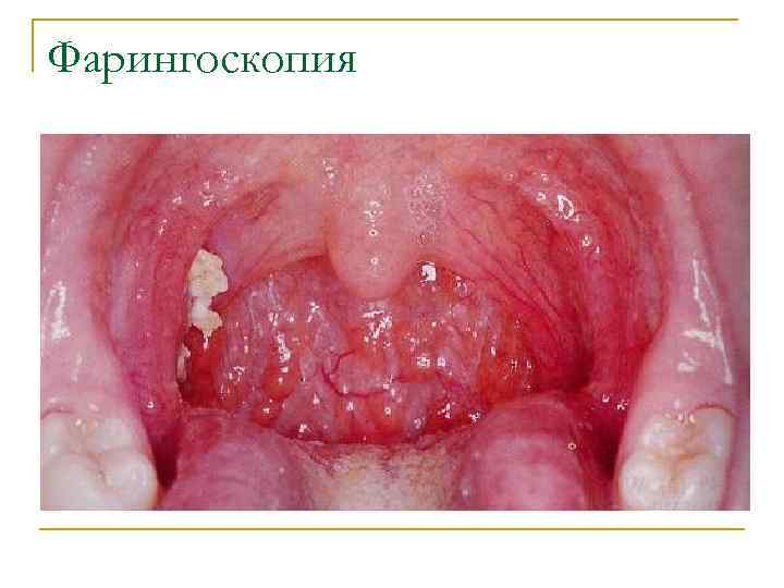 Фарингоскопия 