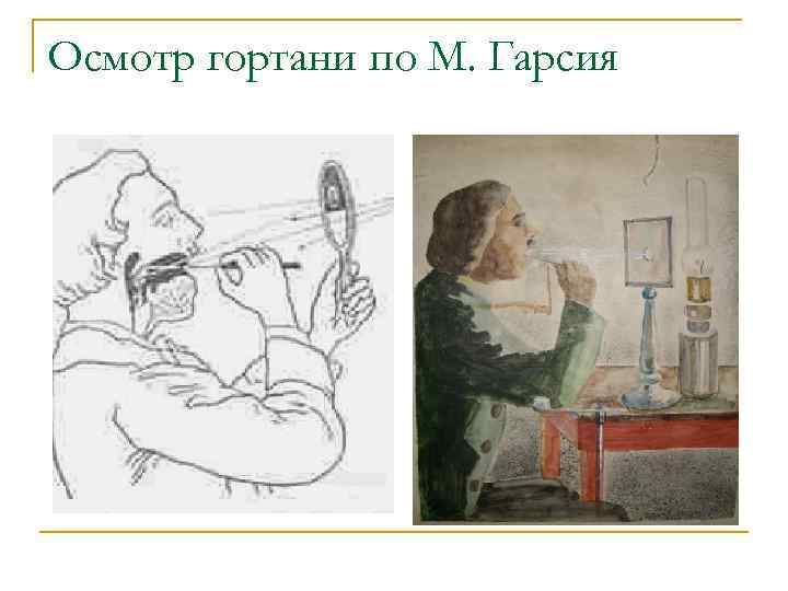 Осмотр гортани по М. Гарсия 