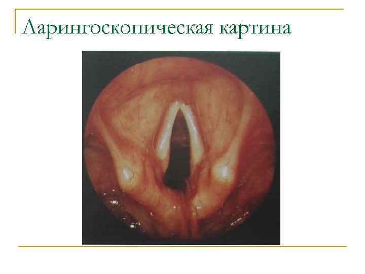 Ларингоскопическая картина 