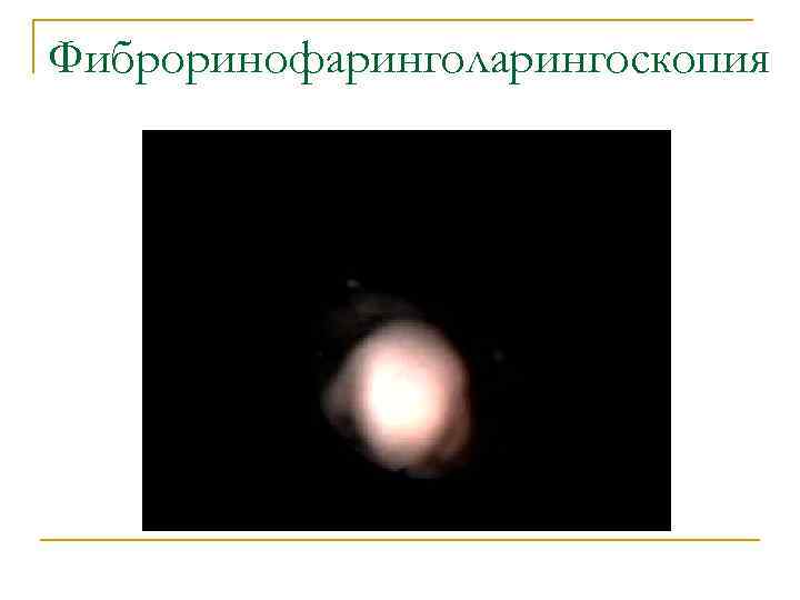 Фиброринофаринголарингоскопия 