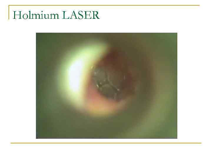 Holmium LASER 