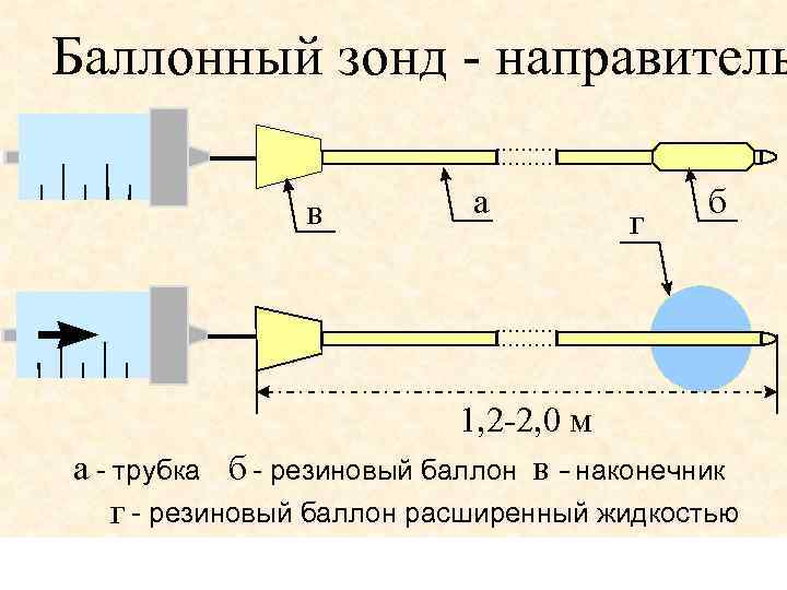Баллонный зонд - направитель в а г б 1, 2 -2, 0 м б