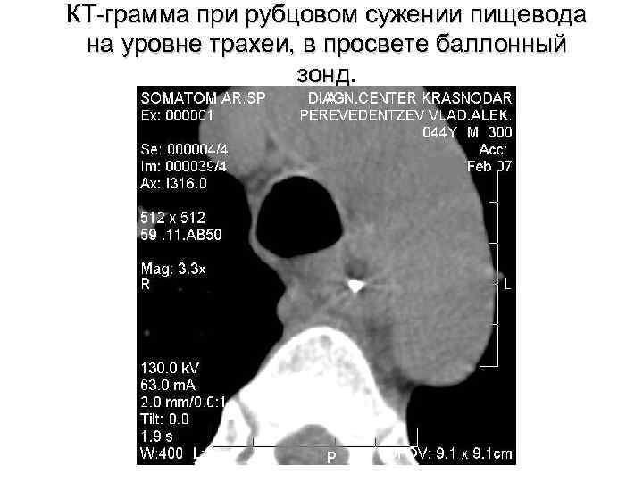 КТ-грамма при рубцовом сужении пищевода на уровне трахеи, в просвете баллонный зонд. 
