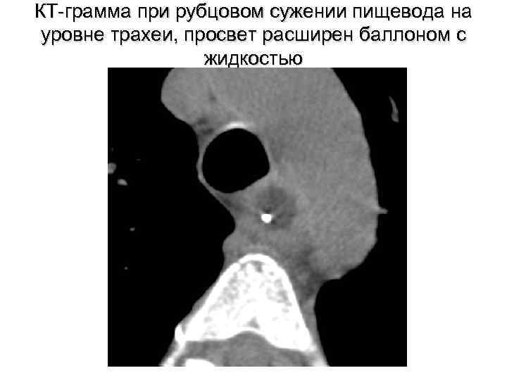 КТ-грамма при рубцовом сужении пищевода на уровне трахеи, просвет расширен баллоном с жидкостью 