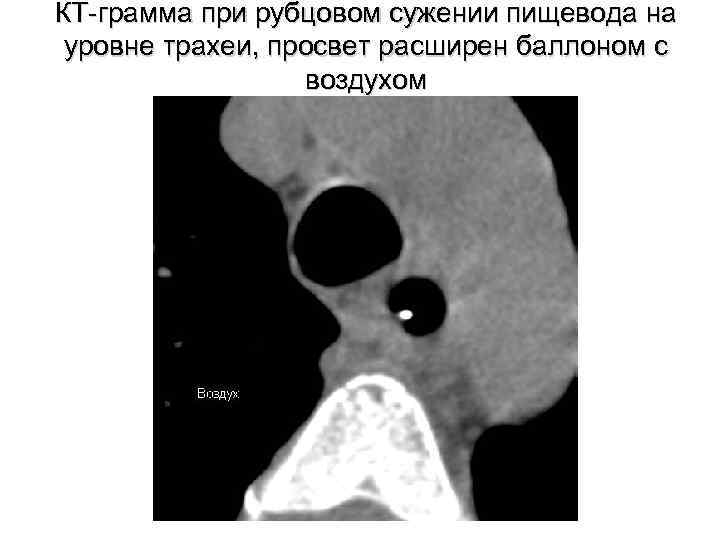 КТ-грамма при рубцовом сужении пищевода на уровне трахеи, просвет расширен баллоном с воздухом 