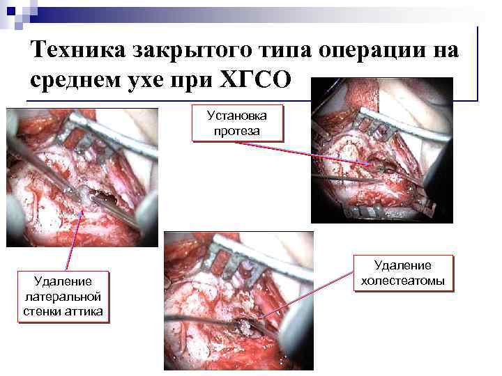 Техника закрытого типа операции на среднем ухе при ХГСО Установка протеза Удаление латеральной стенки