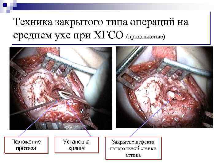 Техника закрытого типа операций на среднем ухе при ХГСО (продолжение) Положение протеза Установка хряща