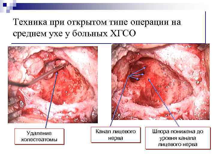 Техника при открытом типе операции на среднем ухе у больных ХГСО Удаление холестеатомы Канал