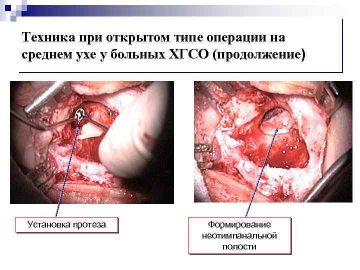 Техника при открытом типе операции на среднем ухе у больных ХГСО (продолжение) Установка протеза